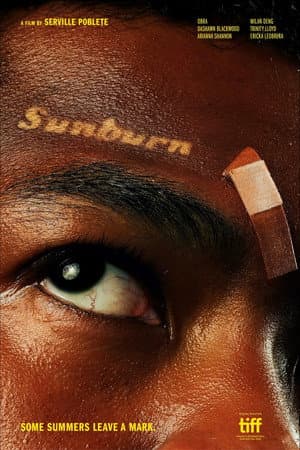 Sunburn